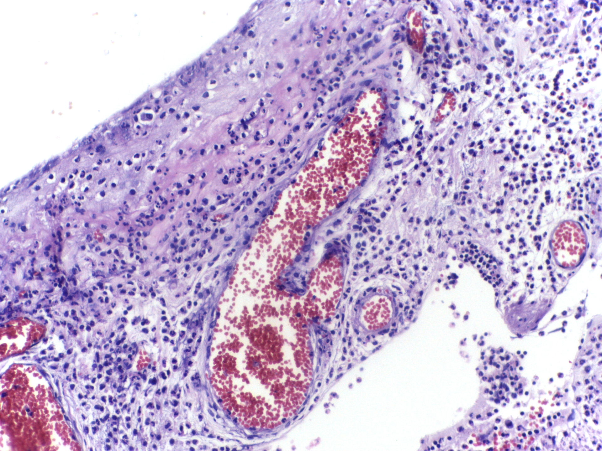 Neutrophil margination and extravasation in acute inflammation