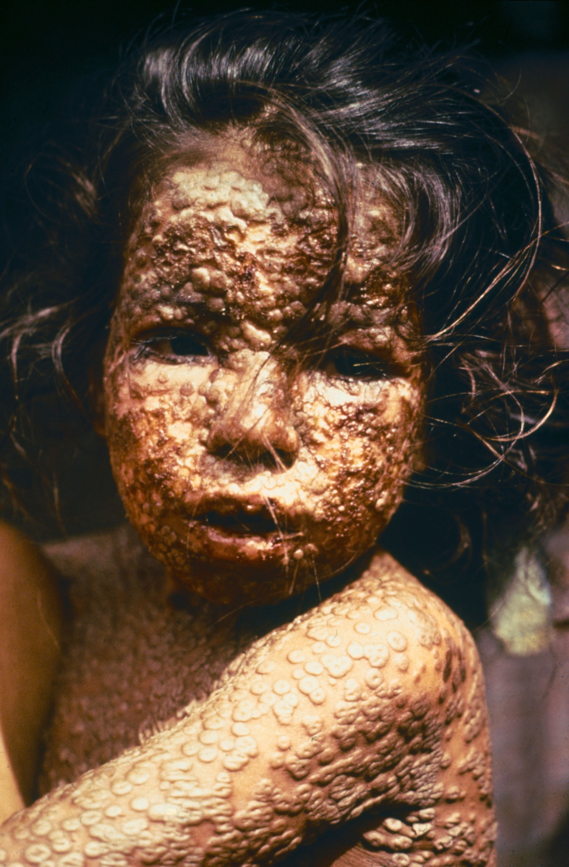 This young girl in Bangladesh was infected with smallpox in 197…