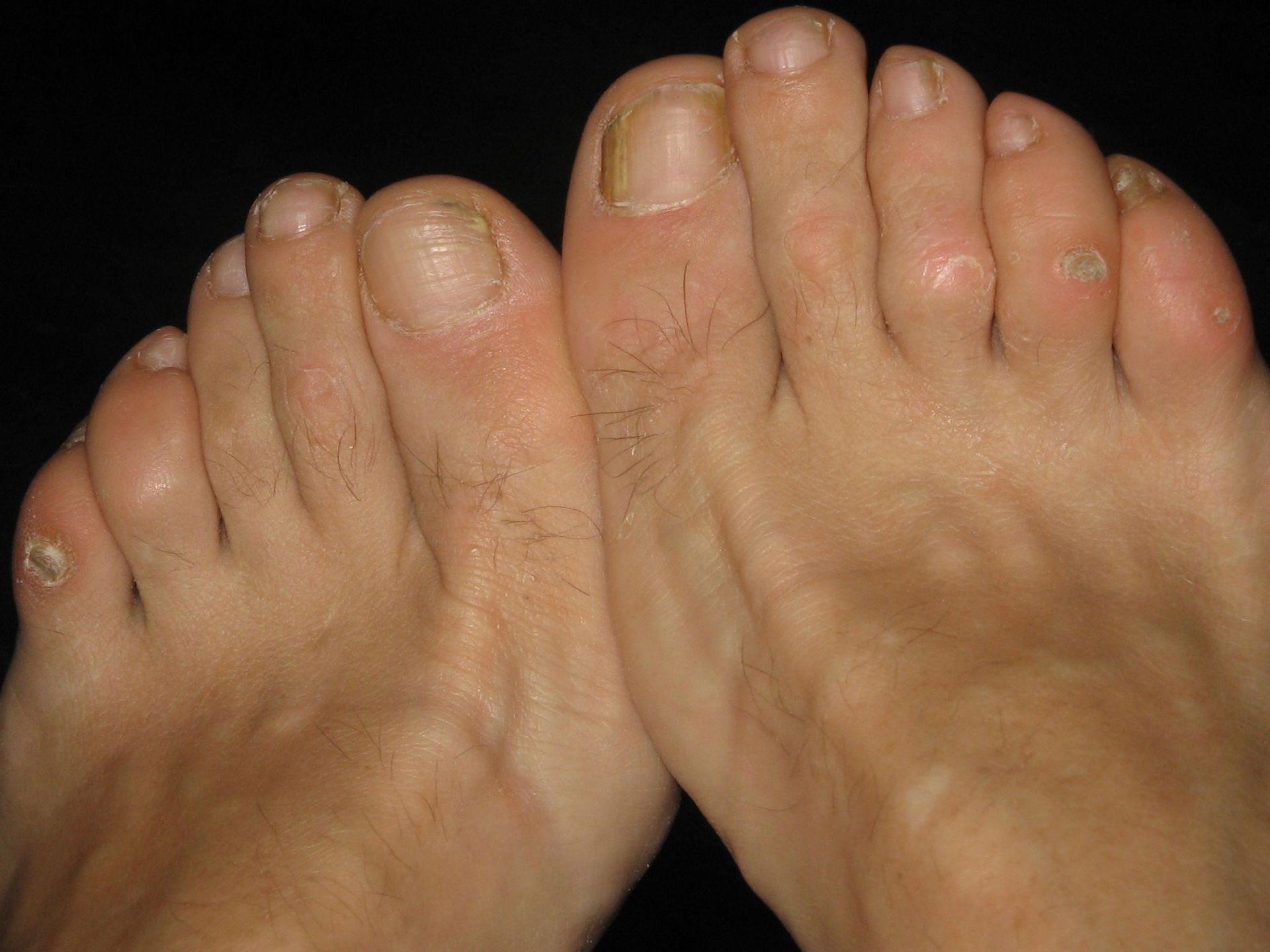 Painful corns at both feet of a 51-year-old woman with severe t…